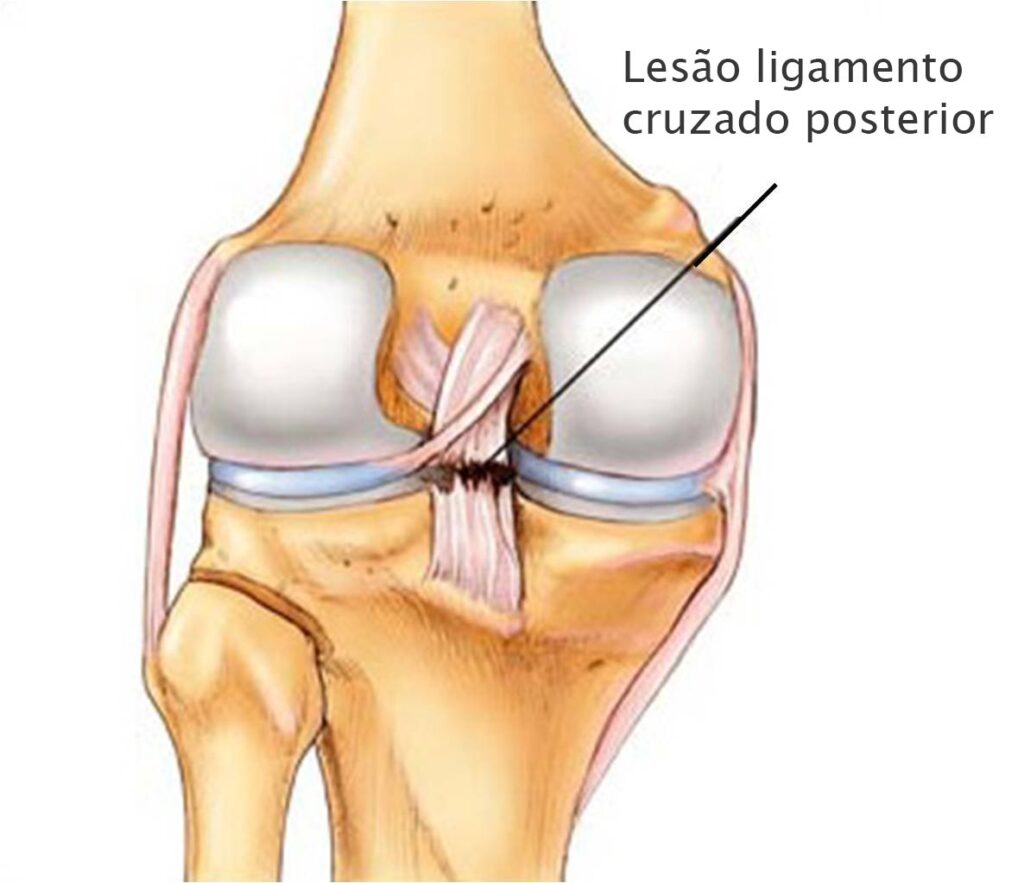 Ligamento Cruzado Posterior Orthos Clinica